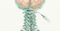 A New Look at Alzheimer's Disease: Roche Tests Spinal ASO Therapy