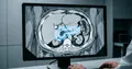 AI在诊断前3年检测出胰腺癌